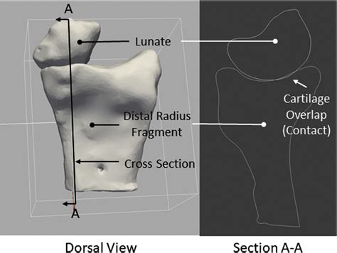 The Effect of Forearm Position on Wrist Joint Biomechanics.
